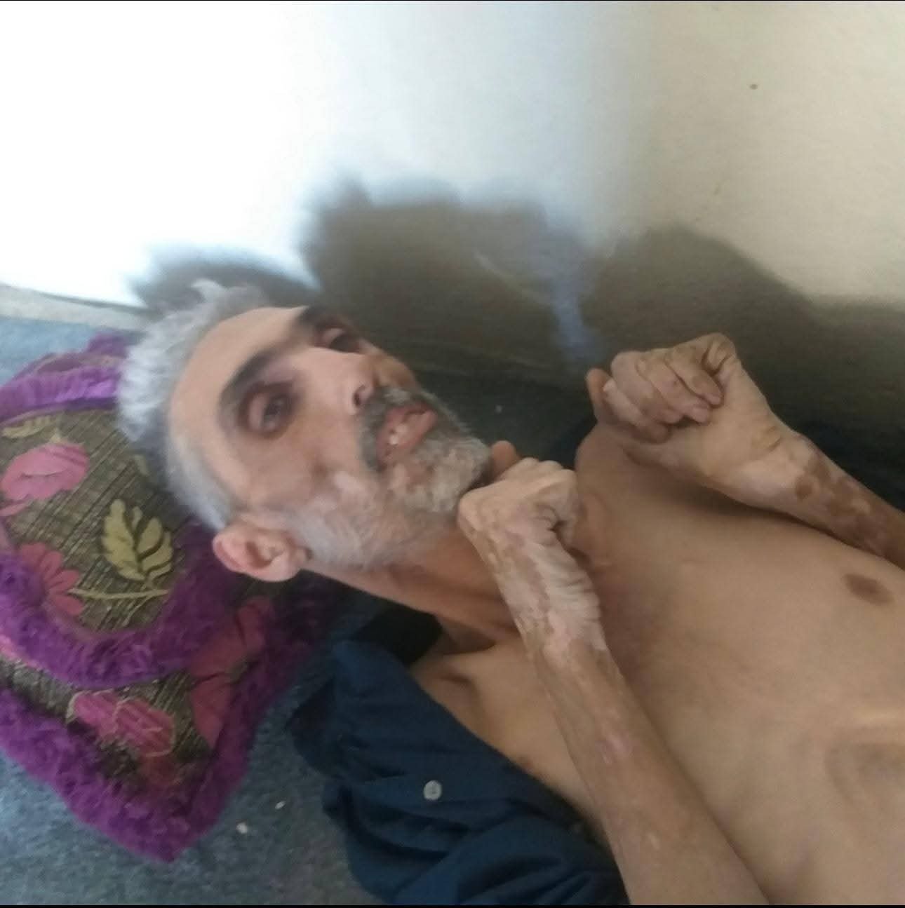 الألم الصامت في منطقة محاصرة: صرخة إنسانية لضحية تعذيب يعاني عجزاً كاملاً وحرماناً من الرعاية المنقذة للحياة